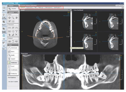 halmadent-OnDemand3D_modul_Dental Dental modul - OnDemand3D szoftver
