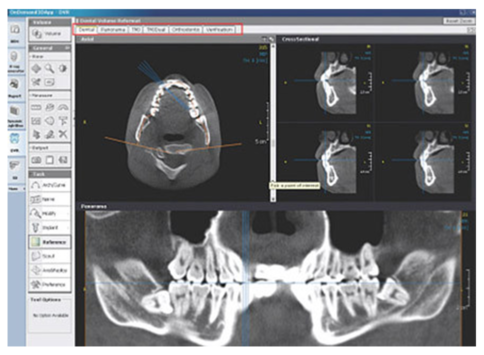halmadent-OnDemand3D_modul_Dental Dental modul - OnDemand3D szoftver