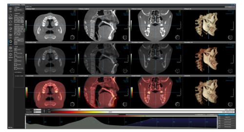 halmadent-OnDemand3D_modul_Fusion Fusion modul - OnDemand3D szoftver