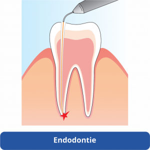 halmadent elexxion lézeres endodoncia