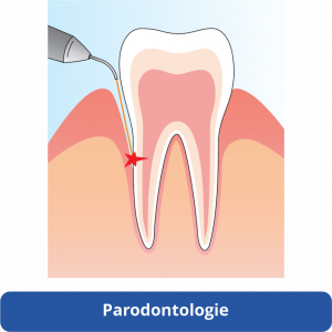 halmadent elexxion lézeres parodontológia