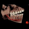 NewTom 7G CT CBCT technológiával - Mandibuláris csatorna