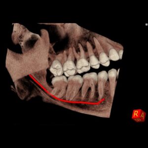 NewTom 7G CT CBCT technológiával - Mandibuláris csatorna