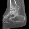 NewTom 7G CT CBCT technológiával - Osteoporotikus ízületi boka