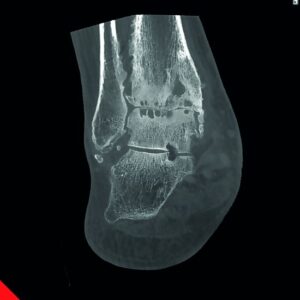 7G osteoporotikus ízületi boka