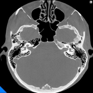 NewTom 7G CT CBCT technológiával - Kétoldali temporális csont