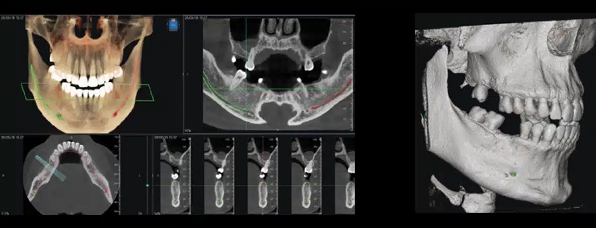 NewTom VG-ONE 2D/3D radiológiai berendezés CEPH karral