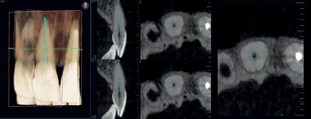 NewTom VG-ONE 2D/3D radiológiai berendezés CEPH karral