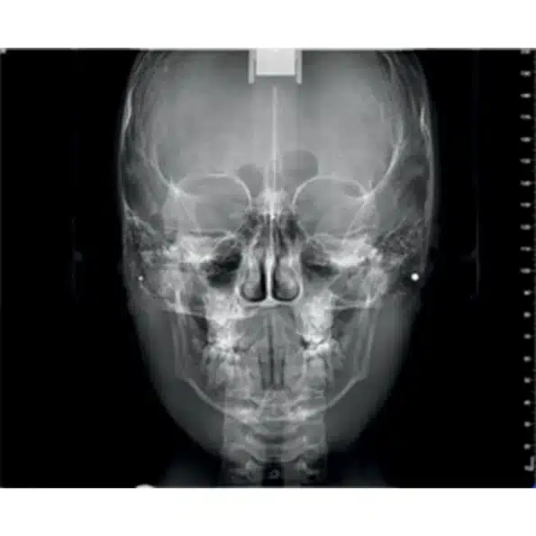 NewTom VG-ONE 2D/3D radiológiai berendezés CEPH karral - Image 9