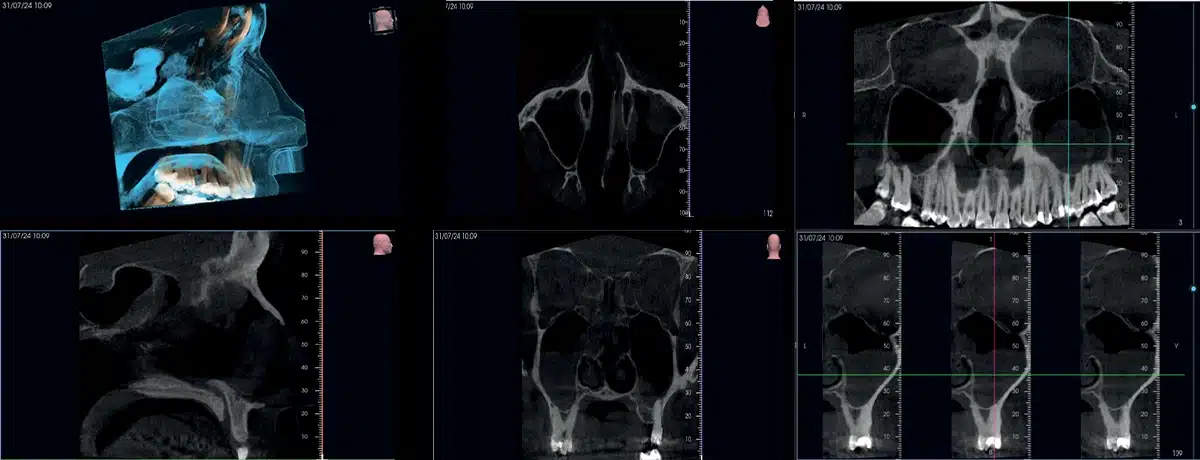 NewTom VG-ONE 2D/3D radiológiai berendezés CEPH karral