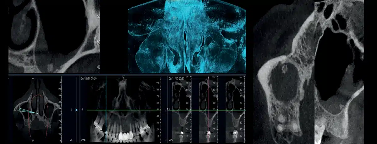 NewTom VG-ONE 2D/3D radiológiai berendezés CEPH karral